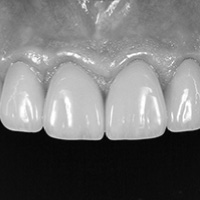 上顎6前歯オールセラミッククラウン両側第一小臼歯ラミネートベニア