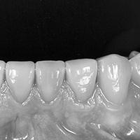 下顎6前歯＆両側第一小臼歯ラミネートベニア